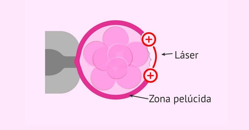 Ilustración médica que muestra la técnica de eclosión asistida (assisted hatching) mediante láser en la zona pelúcida de un embrión.